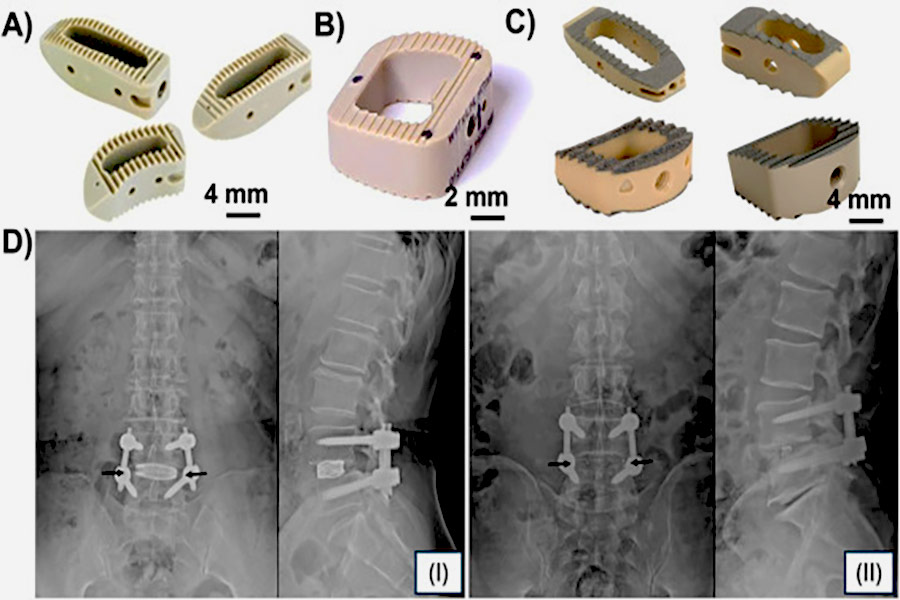 Thread Milling manufactures spinal fusion devices